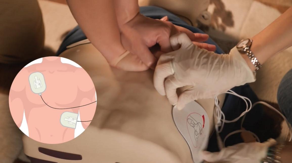 AED pad placement on an adult
