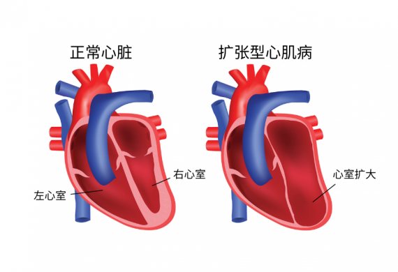 Dilated cardiomyopathy