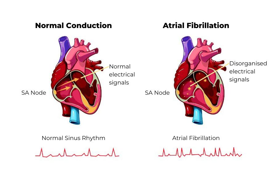 Comparison between normal conduction and atrial fibrillation