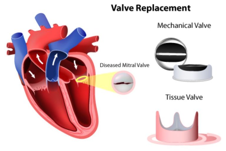 Beyond the Heartbeat: Mitral Valve Disease | Singapore Heart Foundation